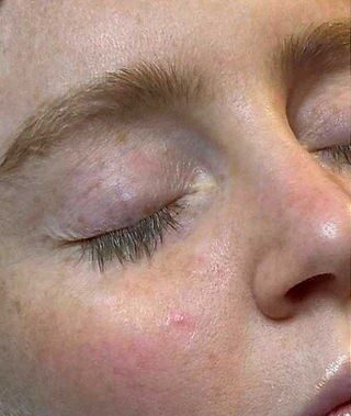 Hydra facial before Hydra facial before