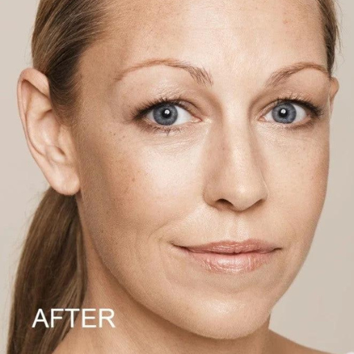 Collagen Stimulator Filler a