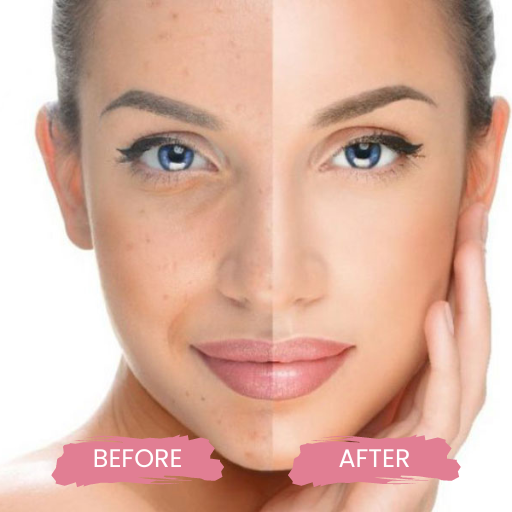 Cutera Limelight Laser 1