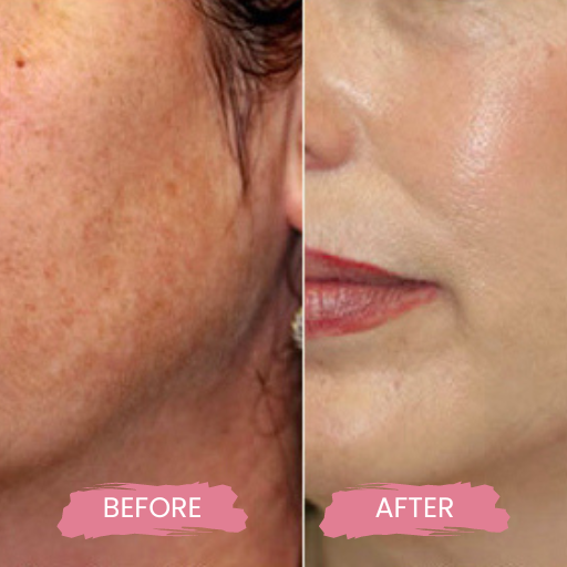 Cutera Limelight Laser 2