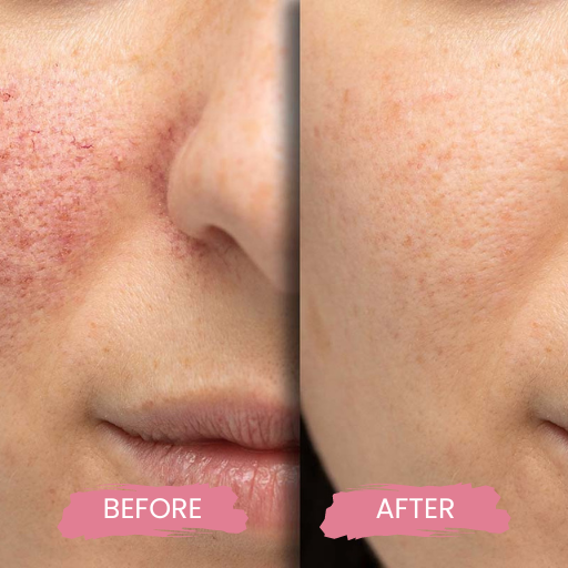 Cutera Limelight Laser 3