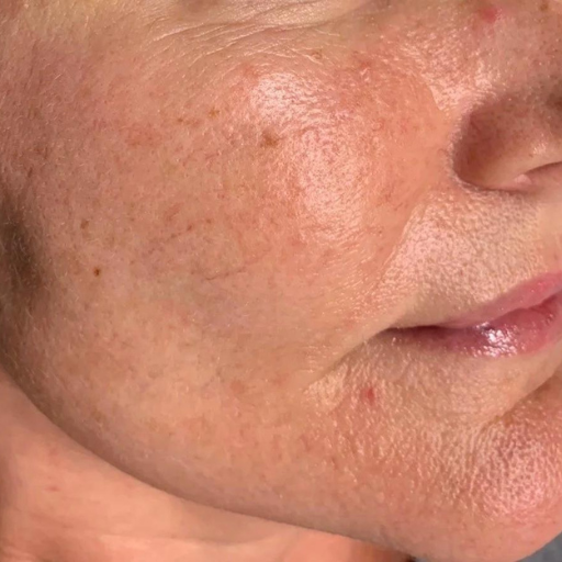 Cutera Limelight Laser b Cutera Limelight Laser b