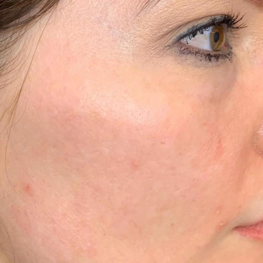 Cutera Secret Pro Revive a