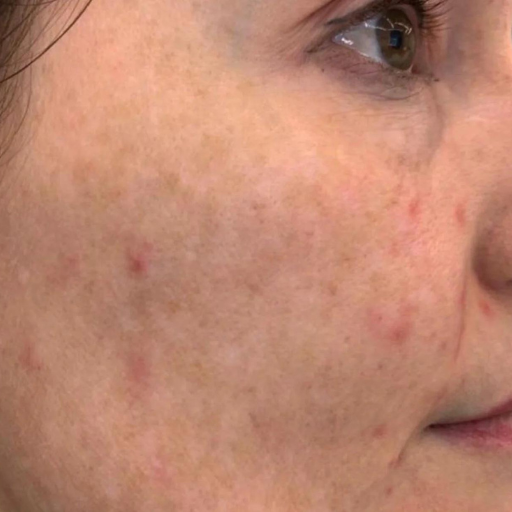 Cutera Secret Pro Revive b Cutera Secret Pro Revive b