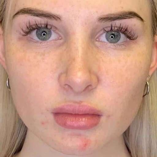 FACE PRP b FACE PRP b