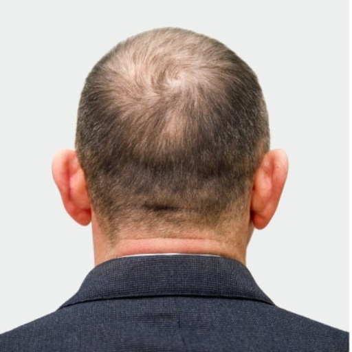 HAIR PRP b HAIR PRP b