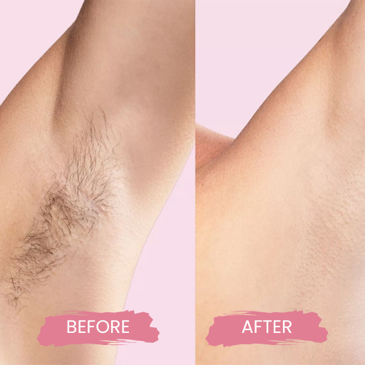 LASER HAIR REMOVAL FOR MEN 1