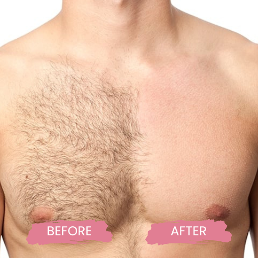 LASER HAIR REMOVAL FOR MEN 1