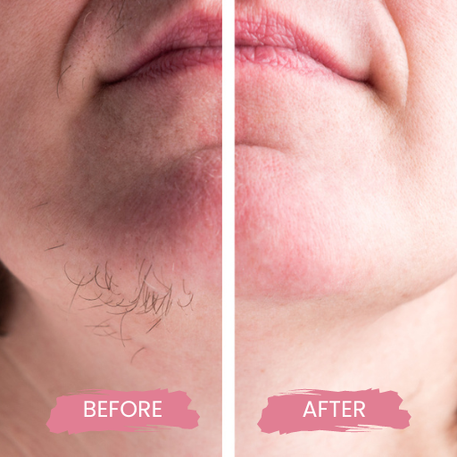 LASER HAIR REMOVAL FOR MEN 3