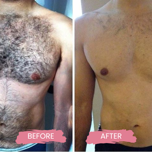 LASER HAIR REMOVAL FOR MEN 3