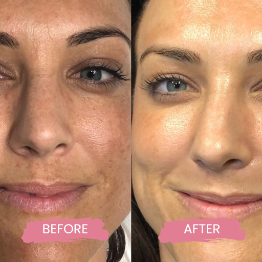 LASER HAIR REMOVAL FOR MEN