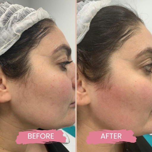 LASER HAIR REMOVAL FOR MEN2