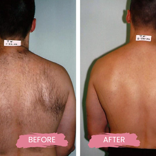LASER HAIR REMOVAL FOR MEN2