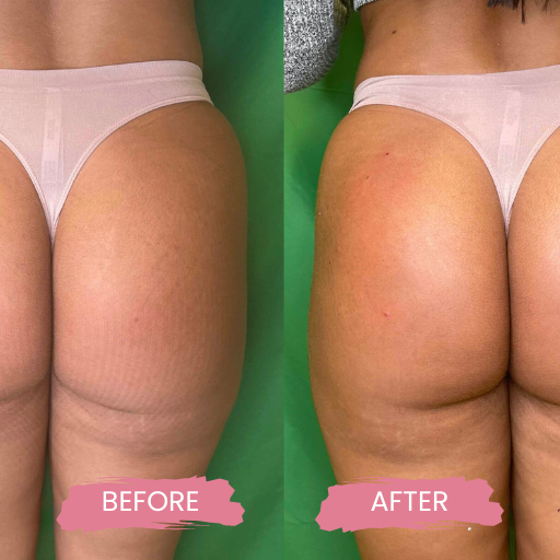Non surgical BBL & BREAST LIFT 2