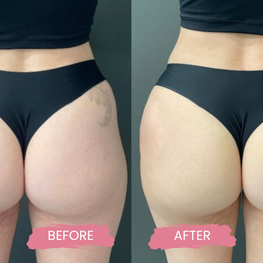 Non surgical BBL & BREAST LIFT 3