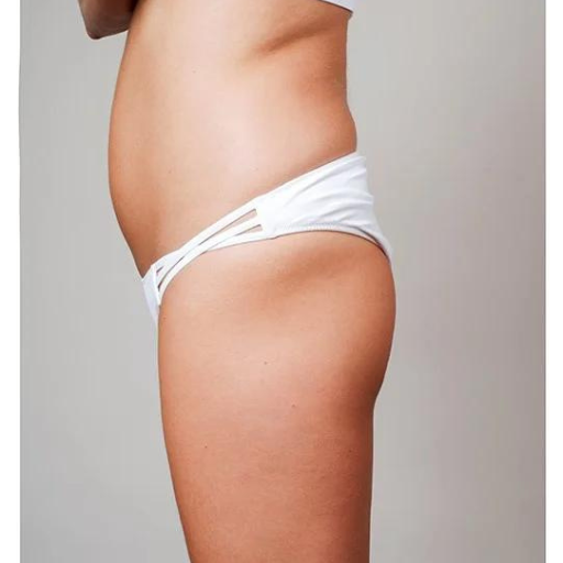 Non surgical BBL & BREAST LIFT b Non surgical BBL & BREAST LIFT b