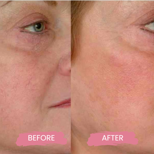 Varicose & Spider Veins 1