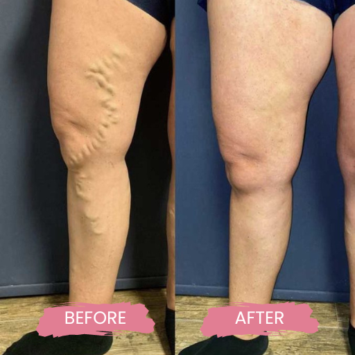 Varicose & Spider Veins 2