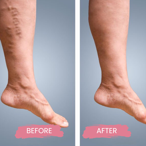 Varicose & Spider Veins 3