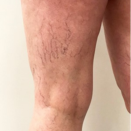 Varicose & Spider Veins B Varicose & Spider Veins B